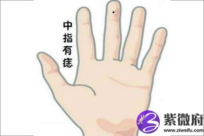 手上长痣 揭秘手上中指痣的含义