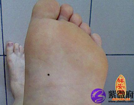揭秘脚底长痣好不好
