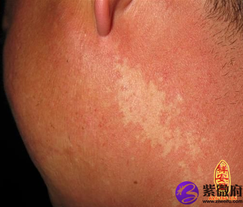关于贫血痣什么是贫血痣贫血痣是一种先天局限性色素减退斑,本病大多
