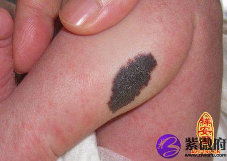 身上胎记位置命运图