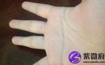 关于感智分叉假断掌是怎么样的呢