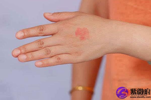 手背胎记的位置与命运怎么看 是好还是坏