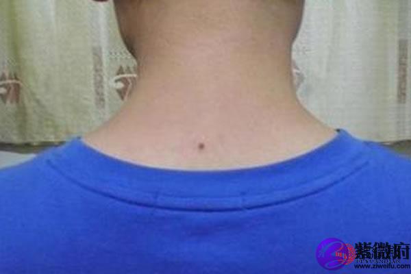 男人脖子后面有痣,男人脖子后面有痣,说明这个男人很有远大的理想和