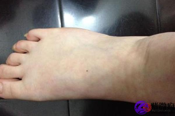 男宝宝右脚背上长胎记代表什么