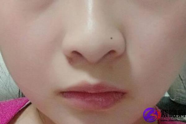 鼻翼的痣是漏财之相吗