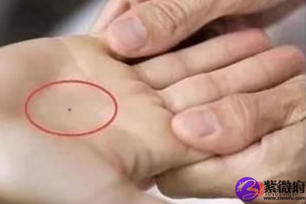 女性右手手心突然长痣