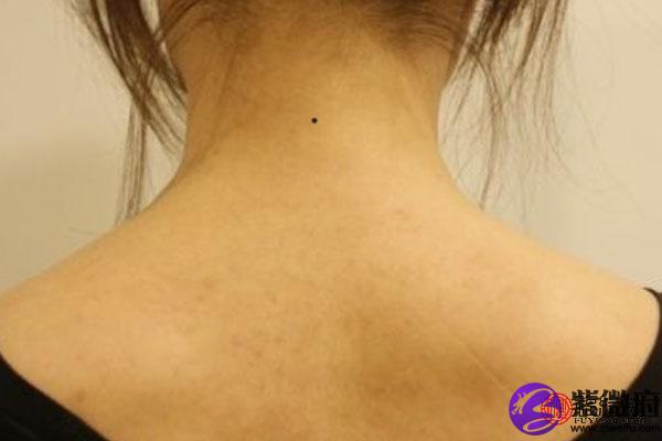 苦情痣是在脖子正中间1寸范围内(一寸约是3厘米)的痣,如果右手臂上有