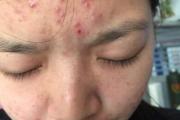 什么样的八字容易长痘女