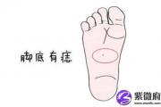 了解算命脚底上长痣是什么意思 脚底长痣好吗