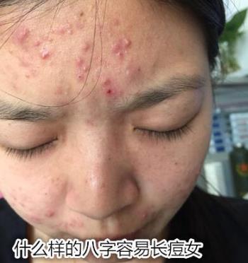 什么样的生辰容易长痘女