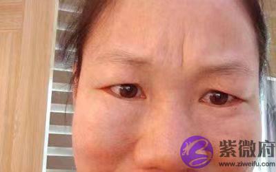 眉心有竖纹的面相说明了什麽应当如何缓解
