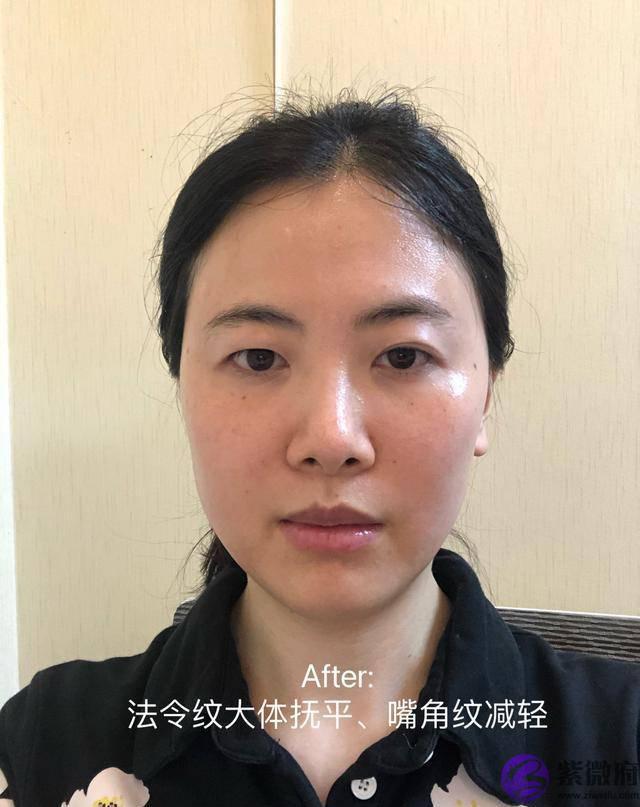 世纪难题“法令纹”，这些年我和法令纹的对抗