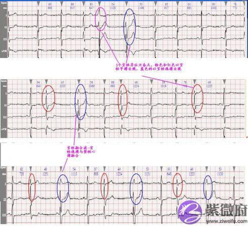 心电图怎麽看图解上的数字正常值，心电图正常值范围