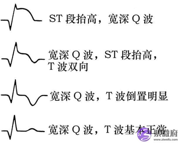 心电图怎麽看图解上的数字正常值，心电图正常值范围