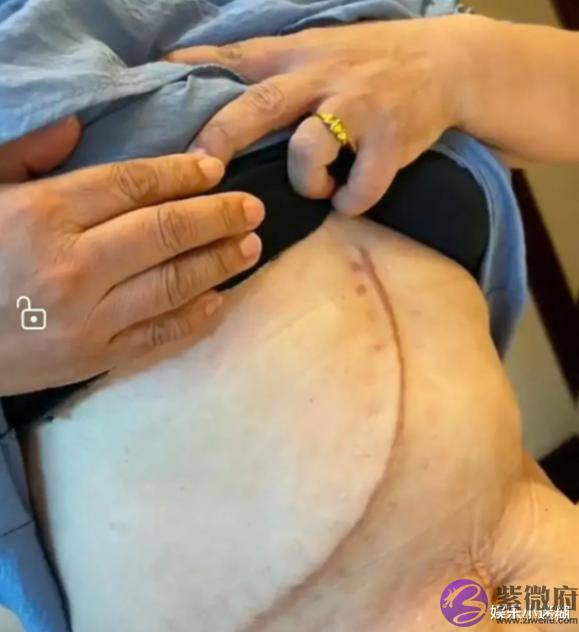 杜新枝晒剖腹产手术刀口，从肚子到身材，网友：糊弄谁呢