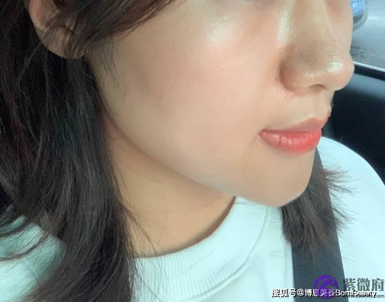 印第安纹怎麽去除？印第安纹能否完全消退？