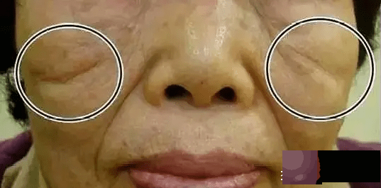 印第安纹填充后有条痕迹是怎麽回事？印第安纹清除有更好方法吗？
