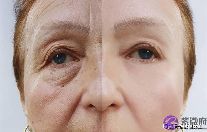 印第安纹在深圳哪里可以解决？印第安纹怎麽去除效果最好？