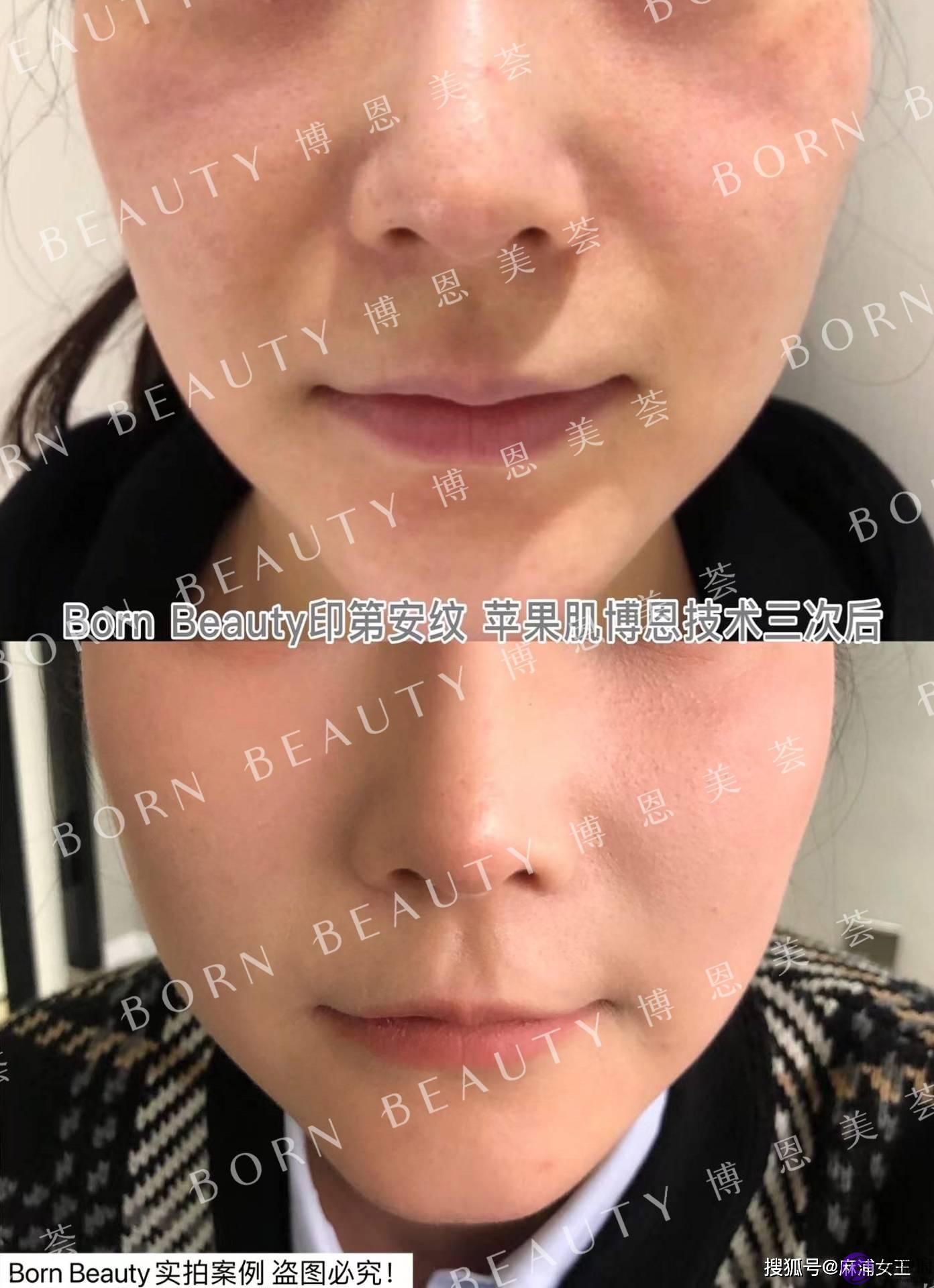 印第安纹在深圳哪里可以解决？印第安纹怎麽去除效果最好？
