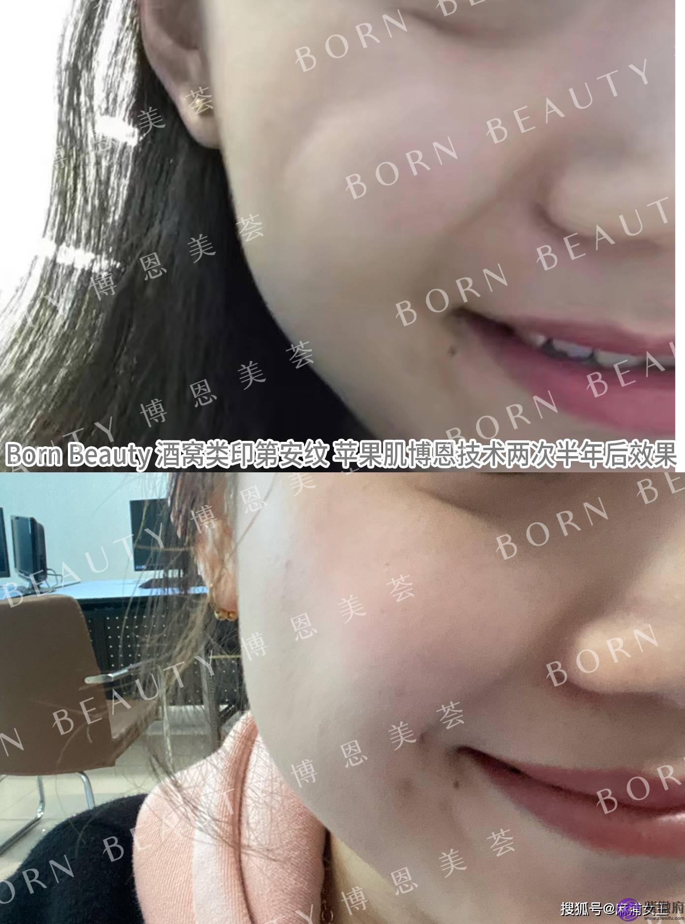 印第安纹在深圳哪里可以解决？印第安纹怎麽去除效果最好？