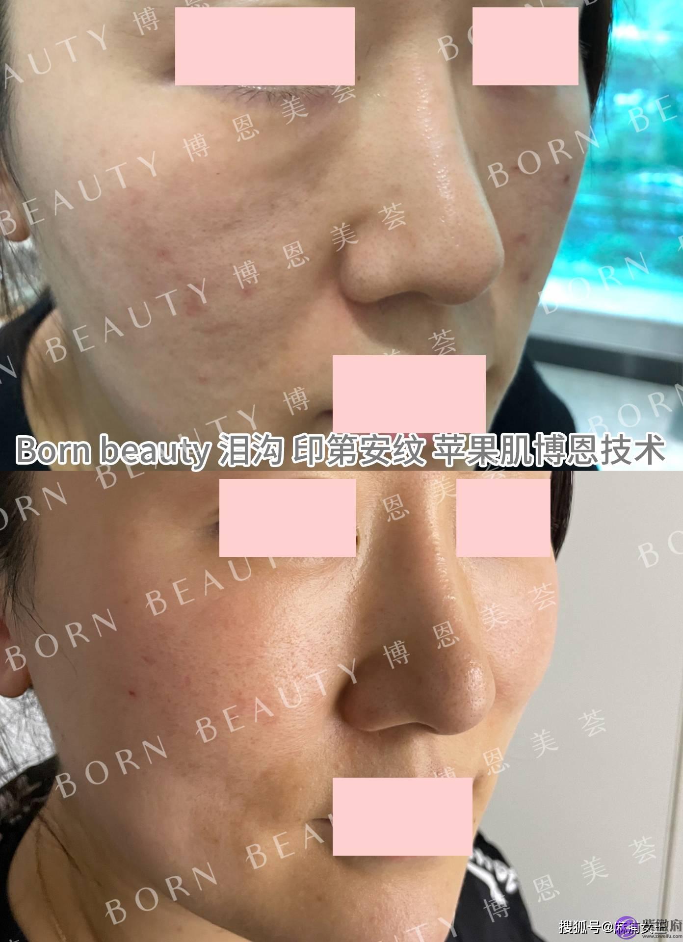 印第安纹在深圳哪里可以解决？印第安纹怎麽去除效果最好？