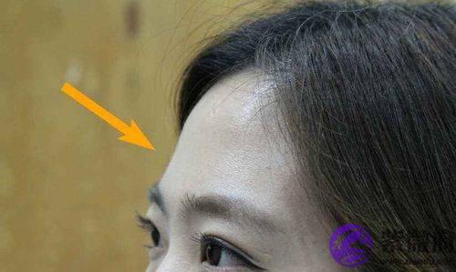 玻尿酸去抬头纹要多少钱