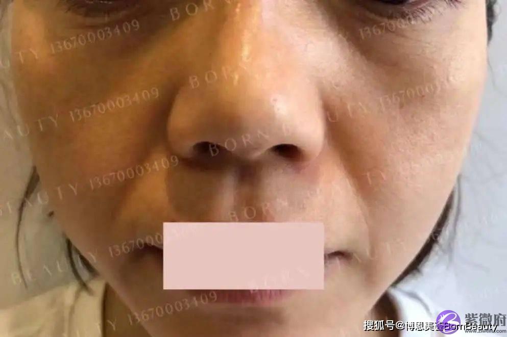 你也有昆凌同款印第安纹？玻尿酸填充印第安纹效果到底怎麽样？