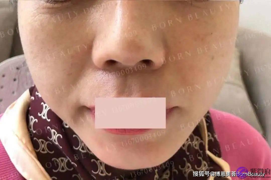 你也有昆凌同款印第安纹？玻尿酸填充印第安纹效果到底怎麽样？
