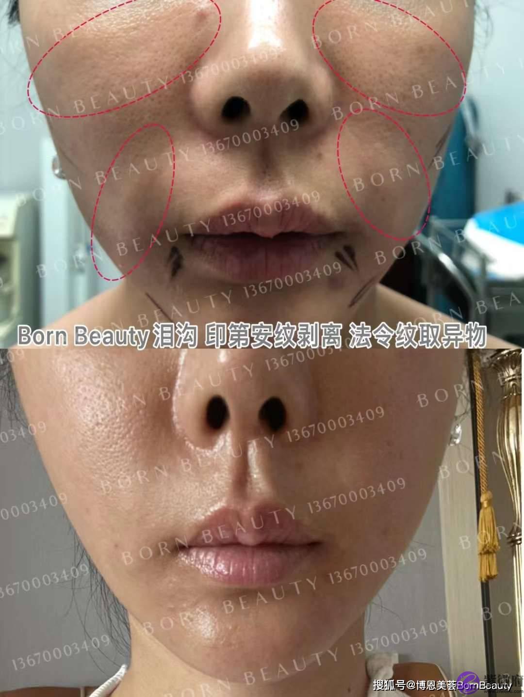 你也有昆凌同款印第安纹？玻尿酸填充印第安纹效果到底怎麽样？