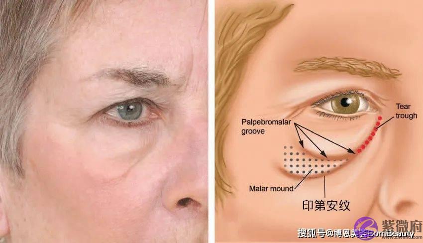 眼睛下面的皱纹是泪沟还是印第安纹？2个方法教你轻松区分泪沟和印第安纹