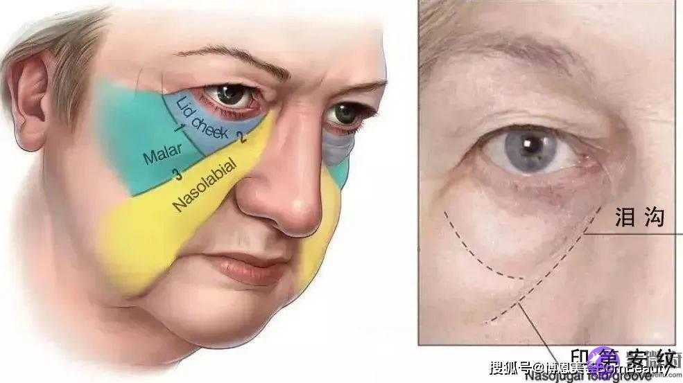 眼睛下面的皱纹是泪沟还是印第安纹？2个方法教你轻松区分泪沟和印第安纹