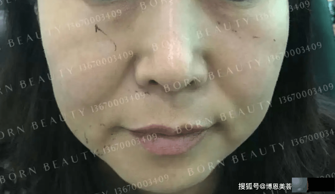 眼睛下面的皱纹是泪沟还是印第安纹？2个方法教你轻松区分泪沟和印第安纹