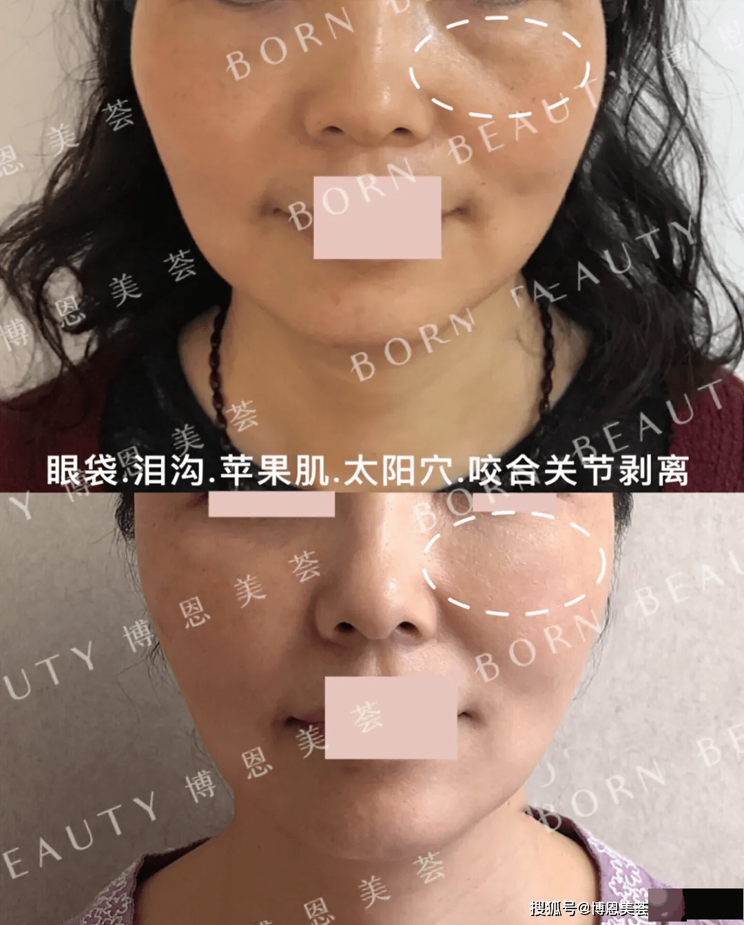 眼睛下面的皱纹是泪沟还是印第安纹？2个方法教你轻松区分泪沟和印第安纹
