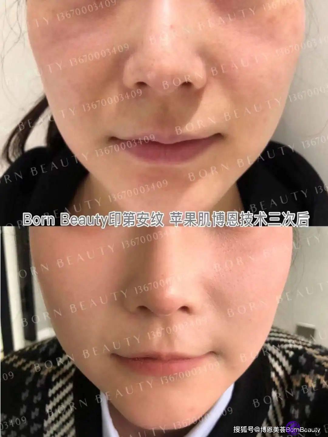 眼睛下面的皱纹是泪沟还是印第安纹？2个方法教你轻松区分泪沟和印第安纹